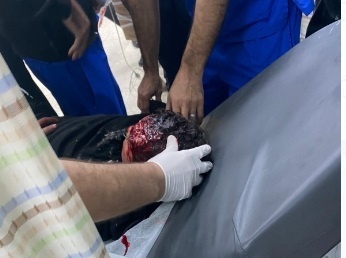 A boy was shot in the head by the occupation during clashes in Jericho