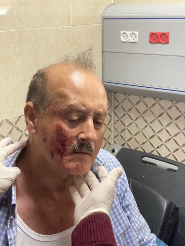 Major General Sarhan Dweikat and a citizen were wounded in an attack by settlers east of Nablus